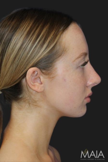 After image 3 Case #116831 - 17 year-old patient | Rhinoplasty 