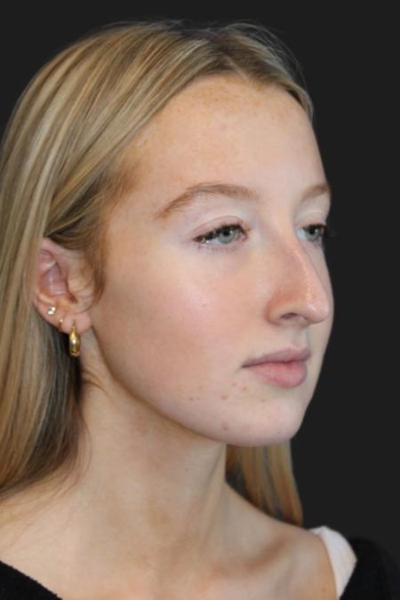 Before image 5 Case #116831 - 17 year-old patient | Rhinoplasty 