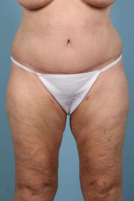 After image 1 Case #116581 - Abdominoplasty