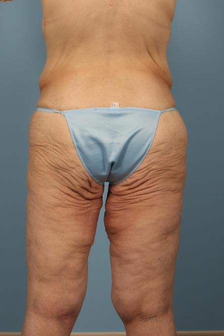 Before image 4 Case #116466 - Weight Loss Contouring