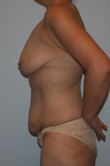 Before image 3 Case #116141 - Massive Weight Loss Contouring - Tummy and Breast