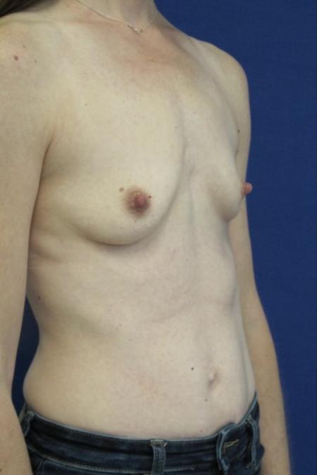 Before image 2 Case #116786 - 41 year-old patient | Breast Augmentation