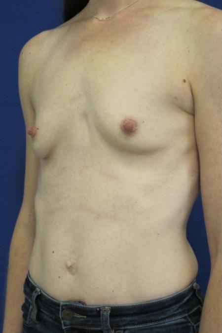 Before image 4 Case #116786 - 41 year-old patient | Breast Augmentation