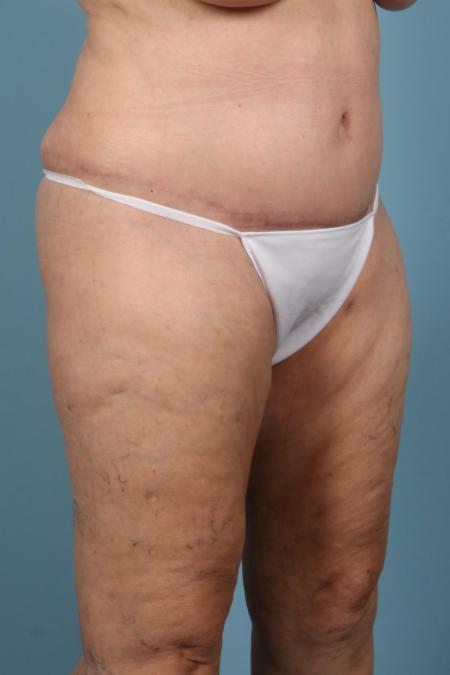 After image 2 Case #116581 - Abdominoplasty