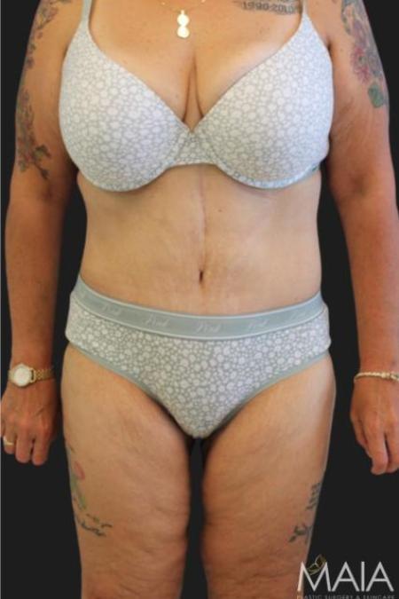 After image 1 Case #116276 - 53 year old patient | Tummy Tuck