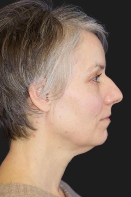 Before image 4 Case #116201 - 49 year-old patient | facial rejuvenation