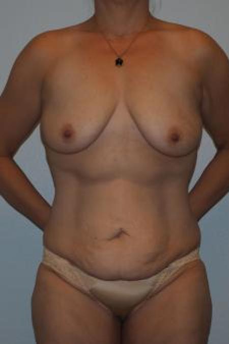 Before image 1 Case #116141 - Massive Weight Loss Contouring - Tummy and Breast