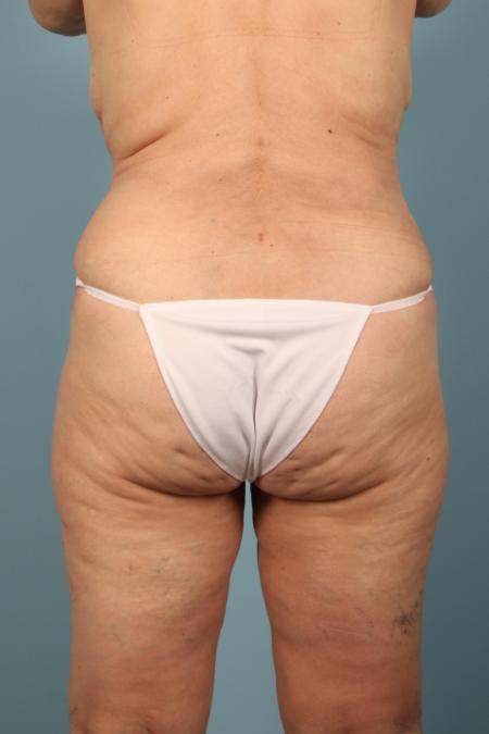 After image 4 Case #116581 - Abdominoplasty