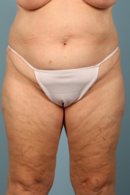 Before image 1 Case #116581 - Abdominoplasty