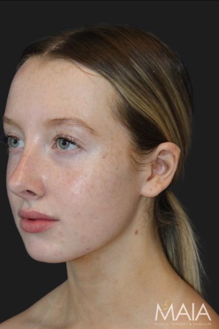 After image 2 Case #116831 - 17 year-old patient | Rhinoplasty 