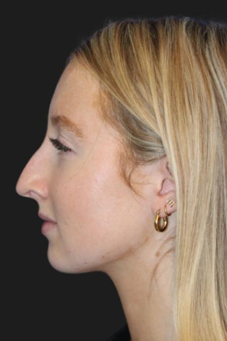 Before image 4 Case #116831 - 17 year-old patient | Rhinoplasty 