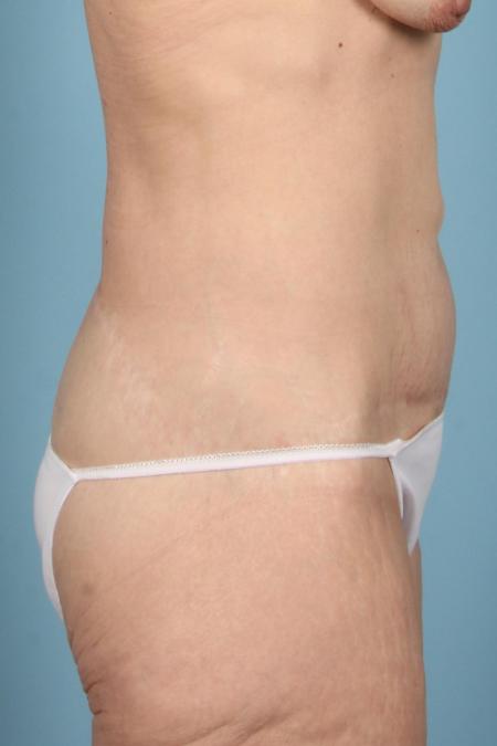 After image 3 Case #116766 - Body Contouring after Weight Loss