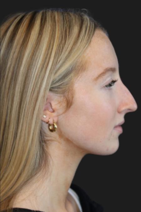 Before image 3 Case #116831 - 17 year-old patient | Rhinoplasty 