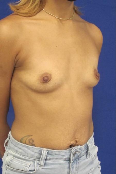 Before image 2 Case #116776 - 30 year-old patient | Breast Augmentation