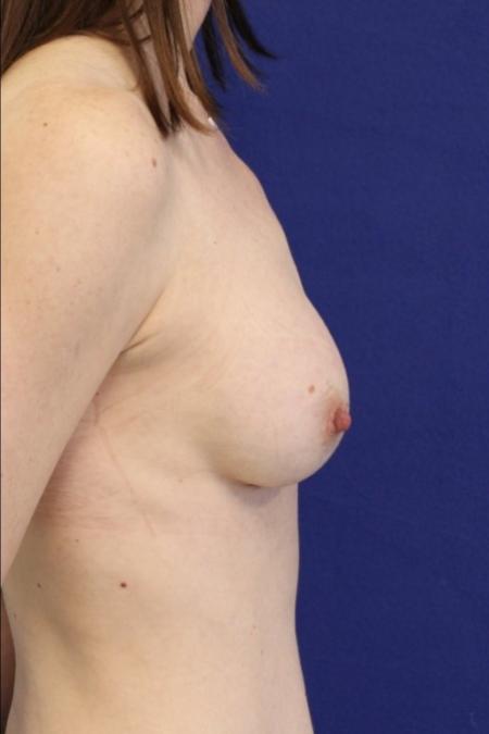 After image 3 Case #116786 - 41 year-old patient | Breast Augmentation