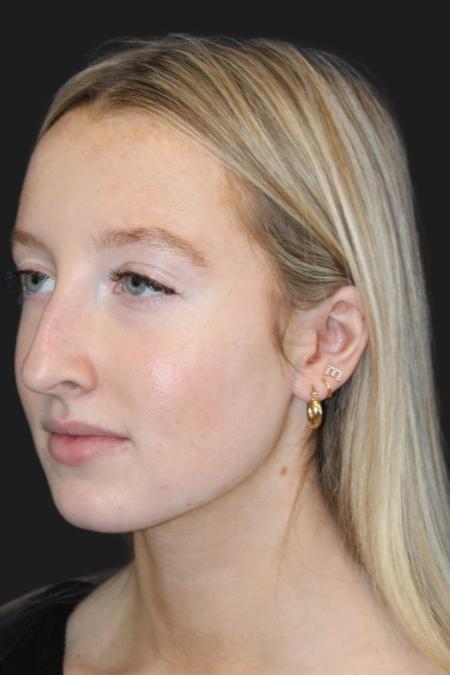 Before image 2 Case #116831 - 17 year-old patient | Rhinoplasty 