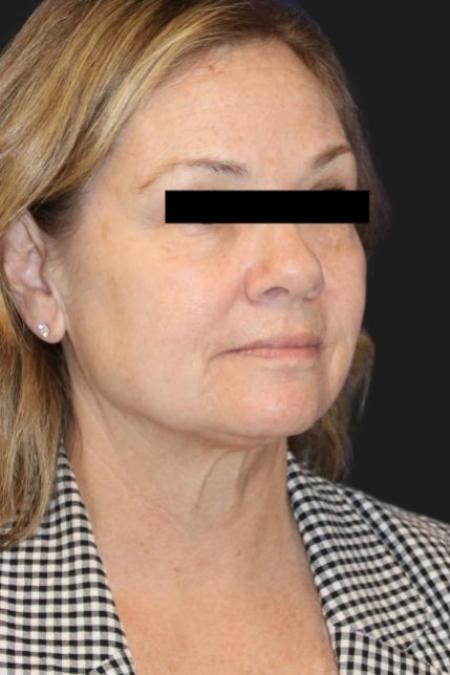 Before image 4 Case #116206 - 64 year-old patient | Facial Rejuvenation