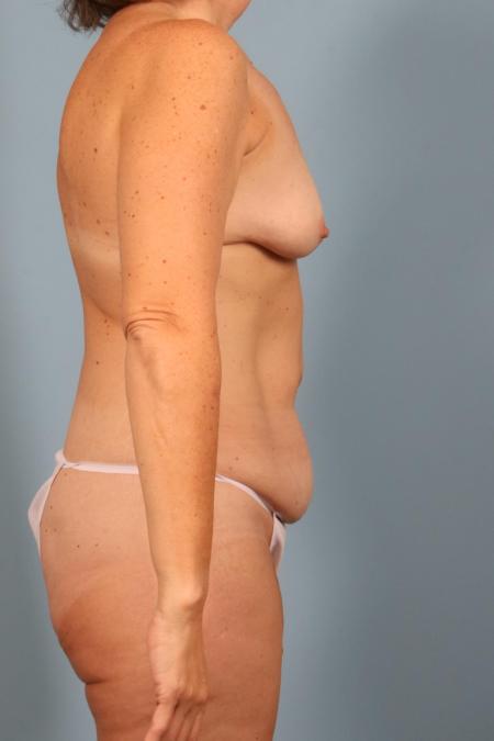 Before image 3 Case #116726 - Weight Loss Contouring (Breast/Body/Arms)