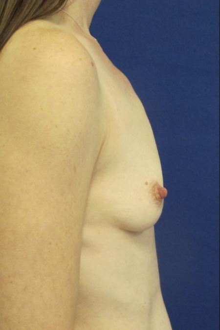 Before image 3 Case #116786 - 41 year-old patient | Breast Augmentation