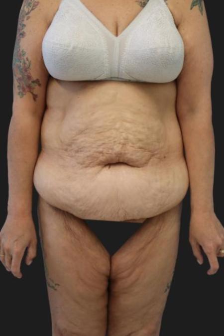 Before image 1 Case #116276 - 53 year old patient | Tummy Tuck