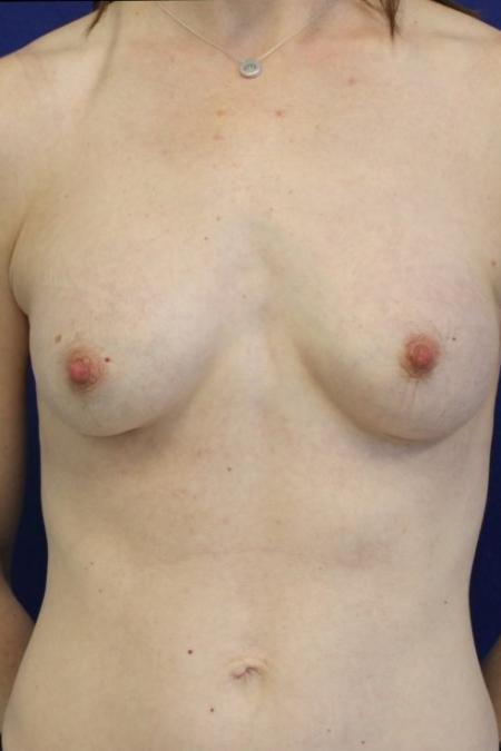 After image 1 Case #116786 - 41 year-old patient | Breast Augmentation