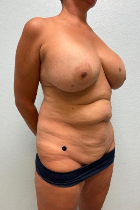 Before image 2 Case #116156 - Mommy Makeover - Mastopexy/Exchange, Tummy Tuck