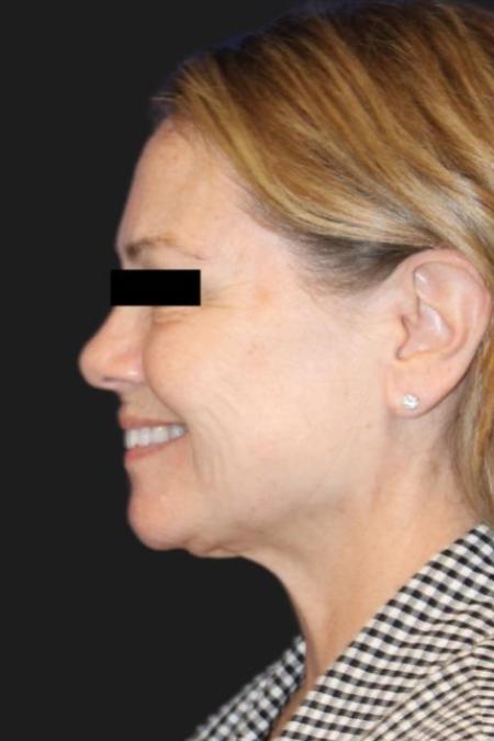 Before image 3 Case #116206 - 64 year-old patient | Facial Rejuvenation