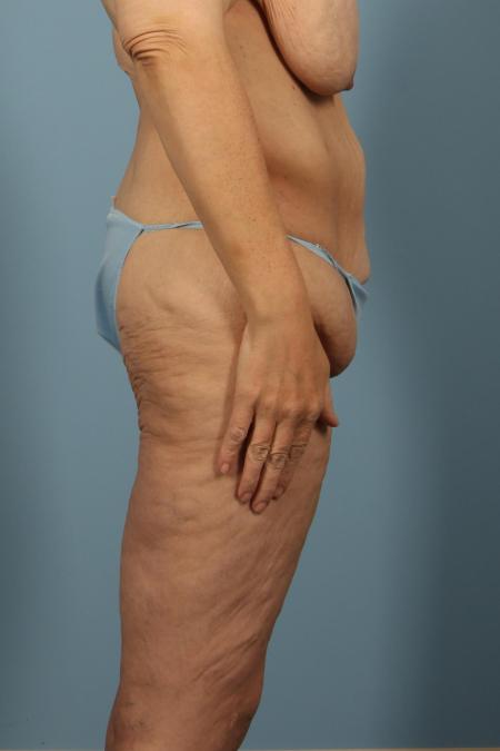 Before image 3 Case #116466 - Weight Loss Contouring