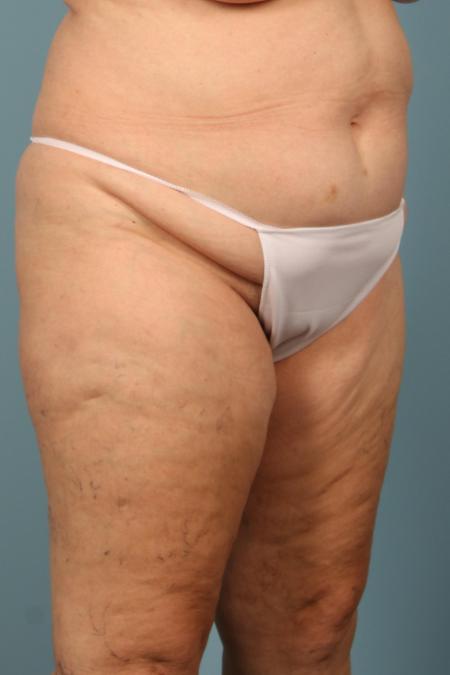 Before image 2 Case #116581 - Abdominoplasty