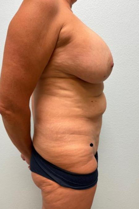 Before image 3 Case #116156 - Mommy Makeover - Mastopexy/Exchange, Tummy Tuck