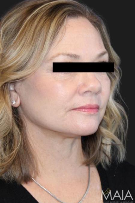 After image 4 Case #116206 - 64 year-old patient | Facial Rejuvenation