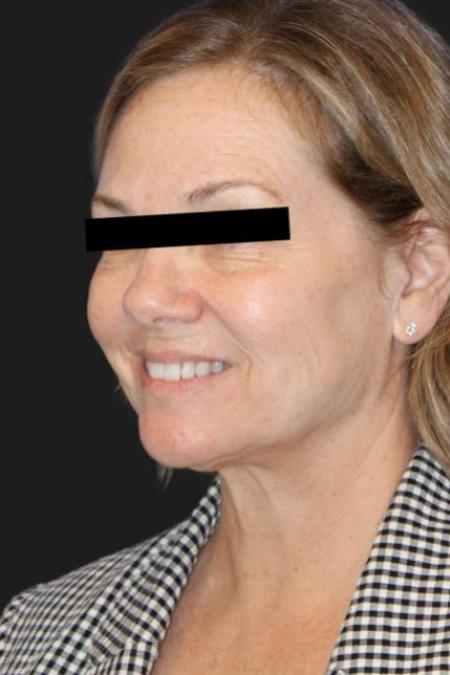 Before image 1 Case #116206 - 64 year-old patient | Facial Rejuvenation