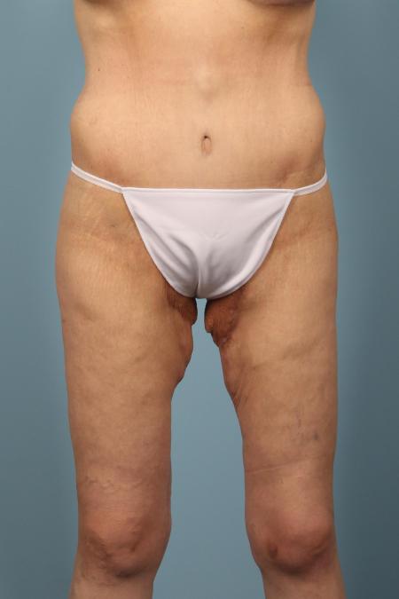 After image 1 Case #116466 - Weight Loss Contouring