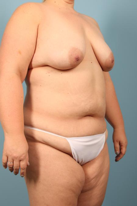 Before image 2 Case #116746 - Weight Loss Contouring (Breast, Arms, Body)