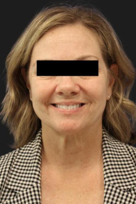 Before image 2 Case #116206 - 64 year-old patient | Facial Rejuvenation