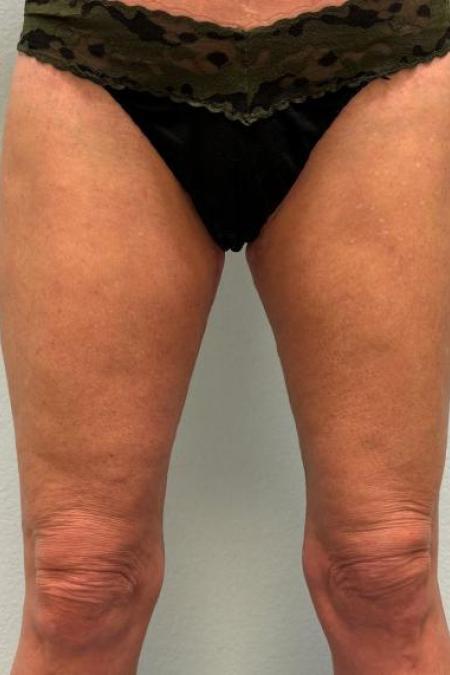 After image 3 Case #116151 - Massive Weight Loss Thigh Lift