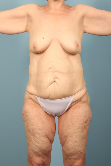 Before image 1 Case #116736 - Weight Loss Contouring (Full Body)