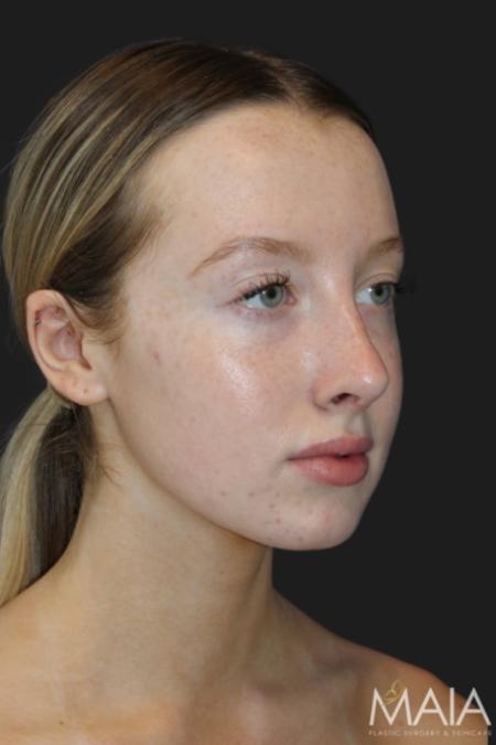 After image 5 Case #116831 - 17 year-old patient | Rhinoplasty 