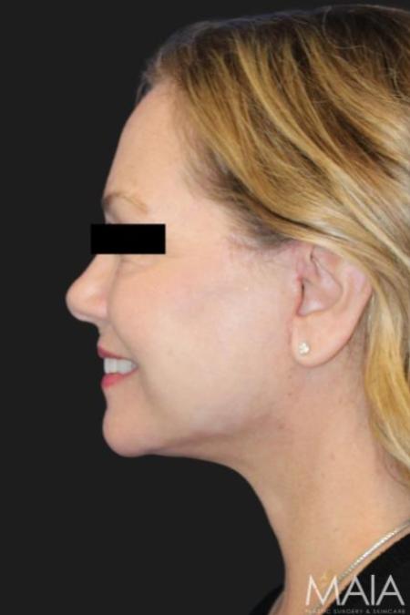 After image 3 Case #116206 - 64 year-old patient | Facial Rejuvenation