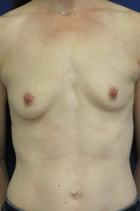 Before image 1 Case #116786 - 41 year-old patient | Breast Augmentation