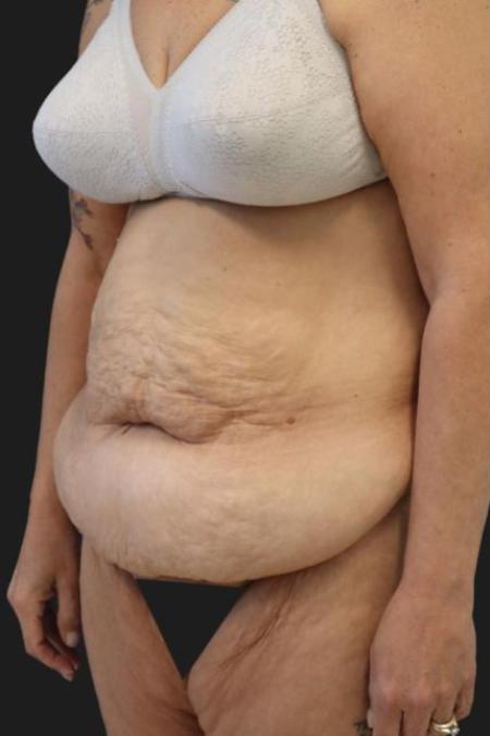 Before image 2 Case #116276 - 53 year old patient | Tummy Tuck