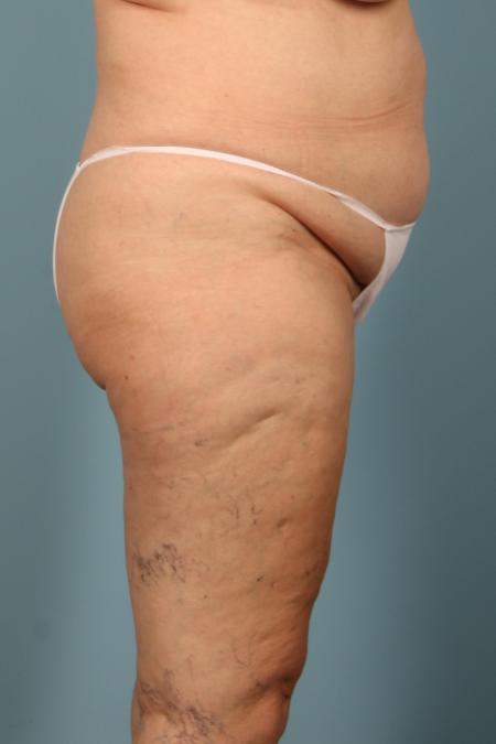 Before image 3 Case #116581 - Abdominoplasty