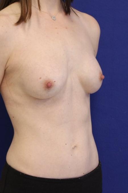 After image 2 Case #116786 - 41 year-old patient | Breast Augmentation