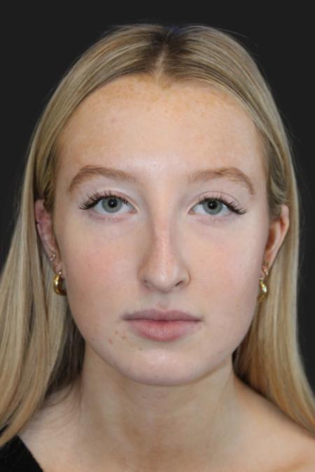 Before image 1 Case #116831 - 17 year-old patient | Rhinoplasty 