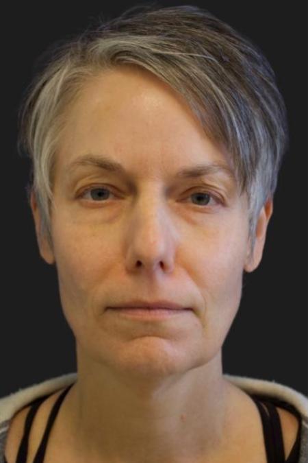 Before image 1 Case #116201 - 49 year-old patient | facial rejuvenation