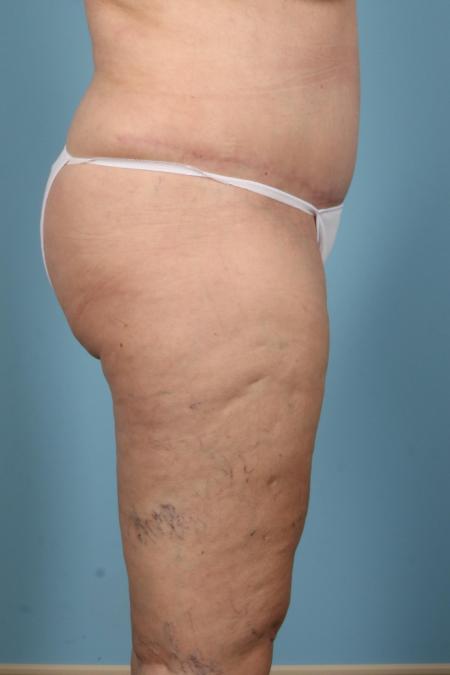 After image 3 Case #116581 - Abdominoplasty