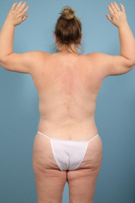 After image 4 Case #116746 - Weight Loss Contouring (Breast, Arms, Body)