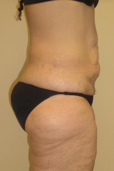 Before image 3 Case #116766 - Body Contouring after Weight Loss