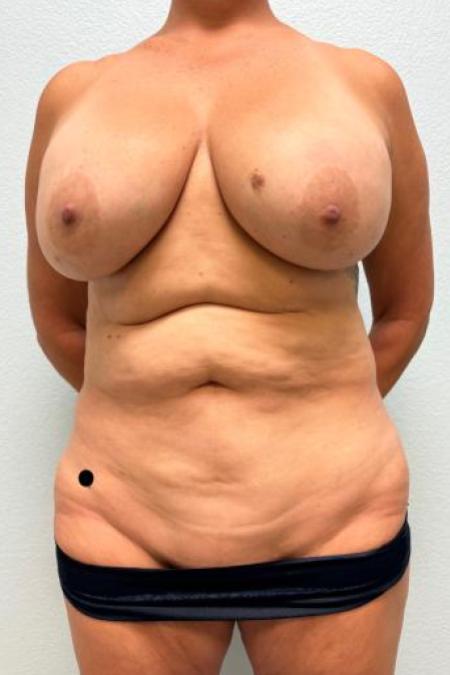 Before image 1 Case #116156 - Mommy Makeover - Mastopexy/Exchange, Tummy Tuck