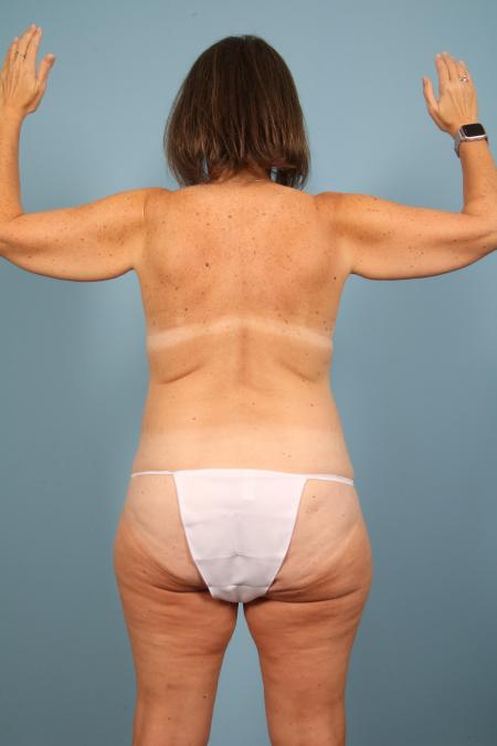 Before image 4 Case #116726 - Weight Loss Contouring (Breast/Body/Arms)